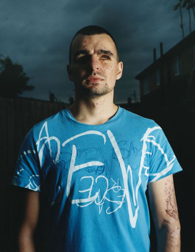 Isolation: A solider with damaged eyes stands in front of the camera, defiant