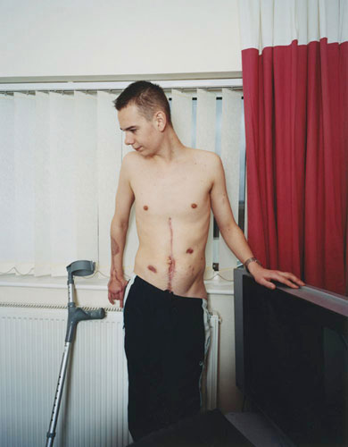 Isolation: A young man stands next to his crutch