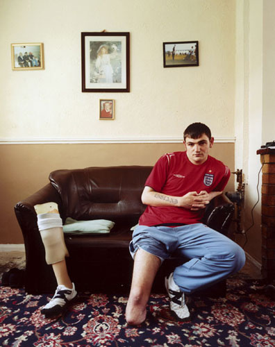 Isolation: A man sits on a sofa, his removed artificial leg leans by his side