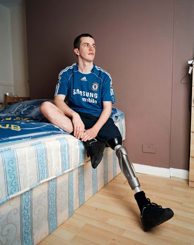 Isolation: A young man with an artificial leg sits on a bed