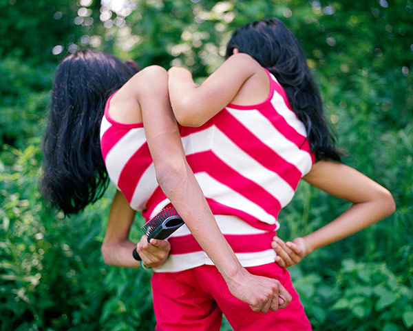 Conjoined twins: Conjoined twins: Carmen and Lupita