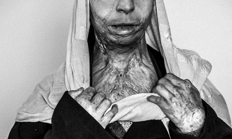 Zahra is 20 years old from Herat. She burned herself 4 years ago