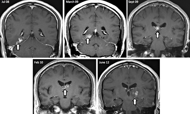 Mans Headaches Due To Tapeworm Living In His Brain For Four Years