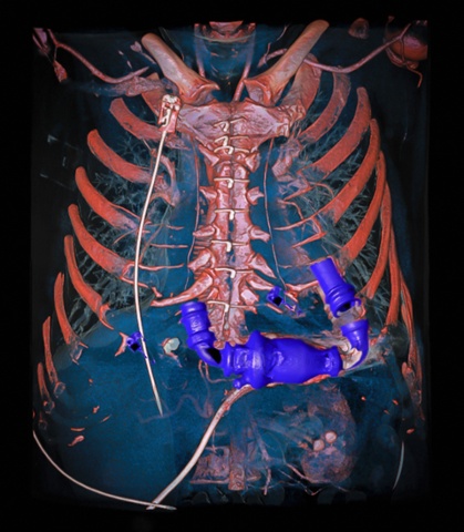 Mechanical heart pump in the thorax, as revealed by a dual energy tomography angiography of a human chest.