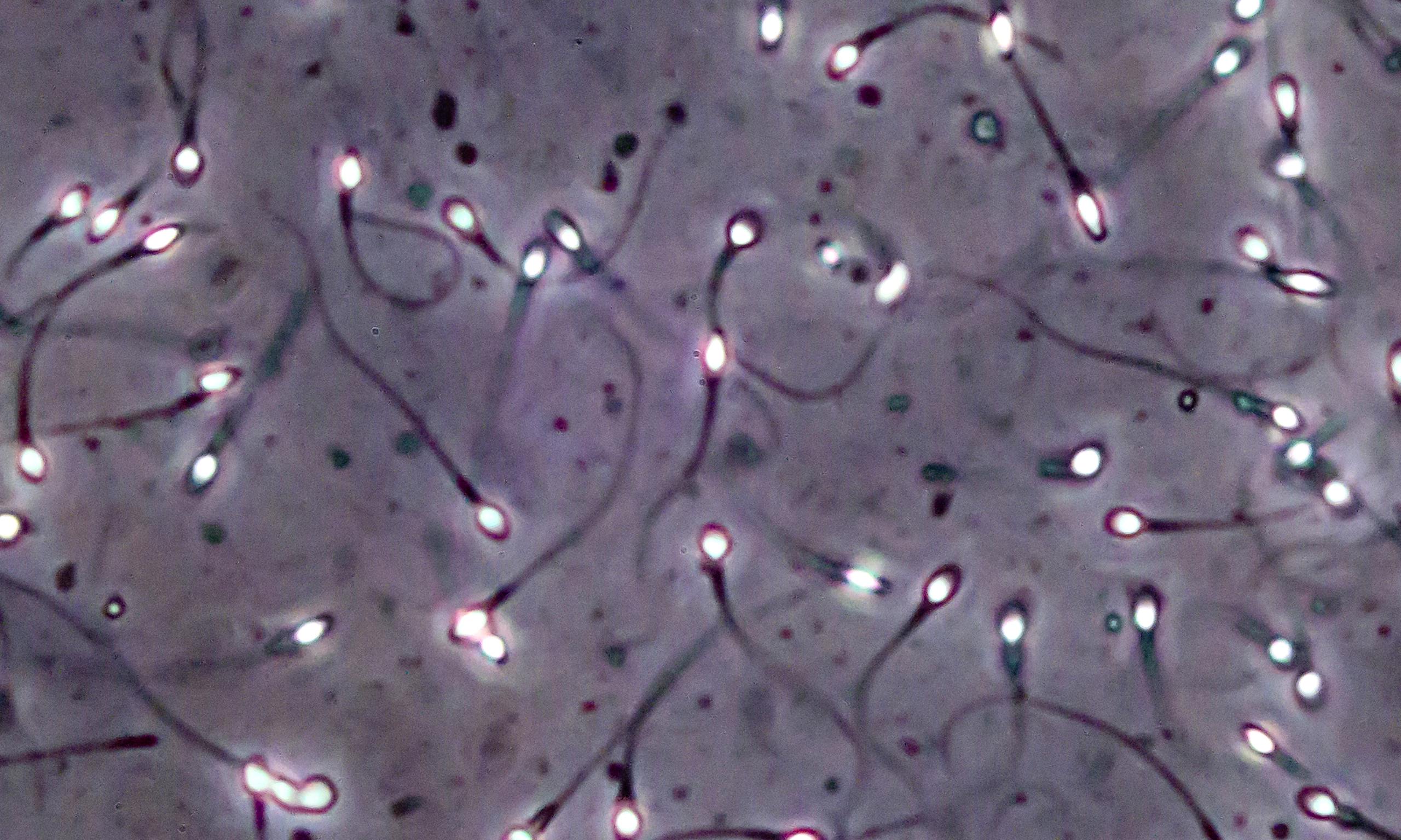 Study Turns Skin Tissue From Infertile Men Into Earlystage Sperm Cells