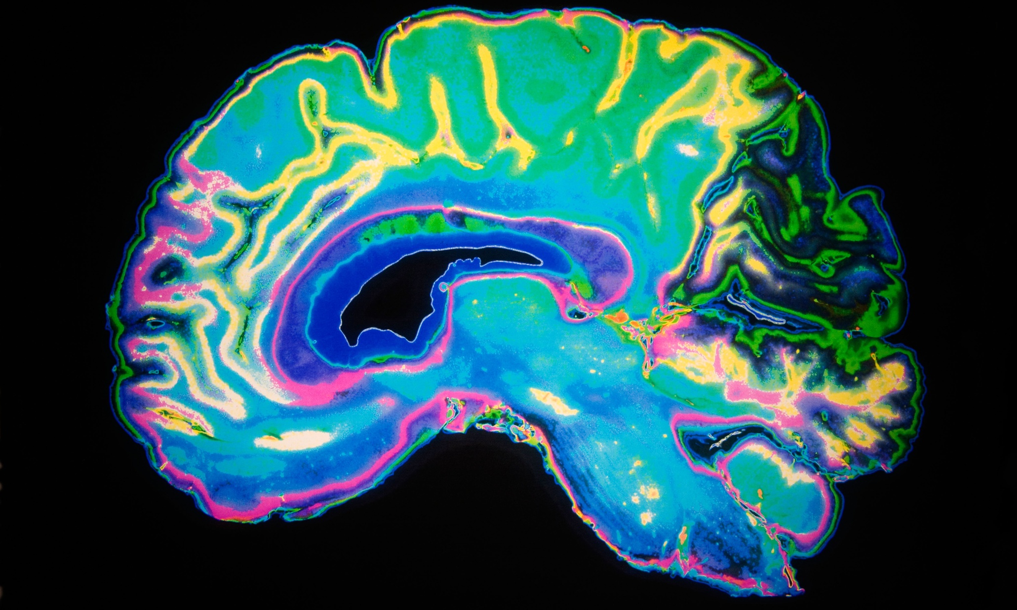 Alzheimer's drug trial shows promising early results